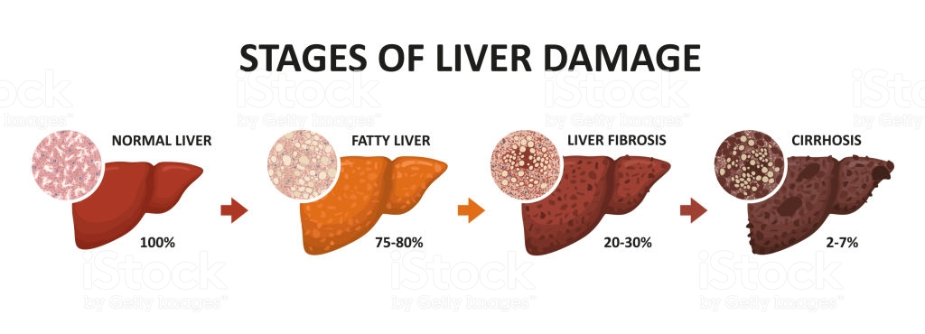 Everything You Need To Know About Cirrhosis The Liver Killer