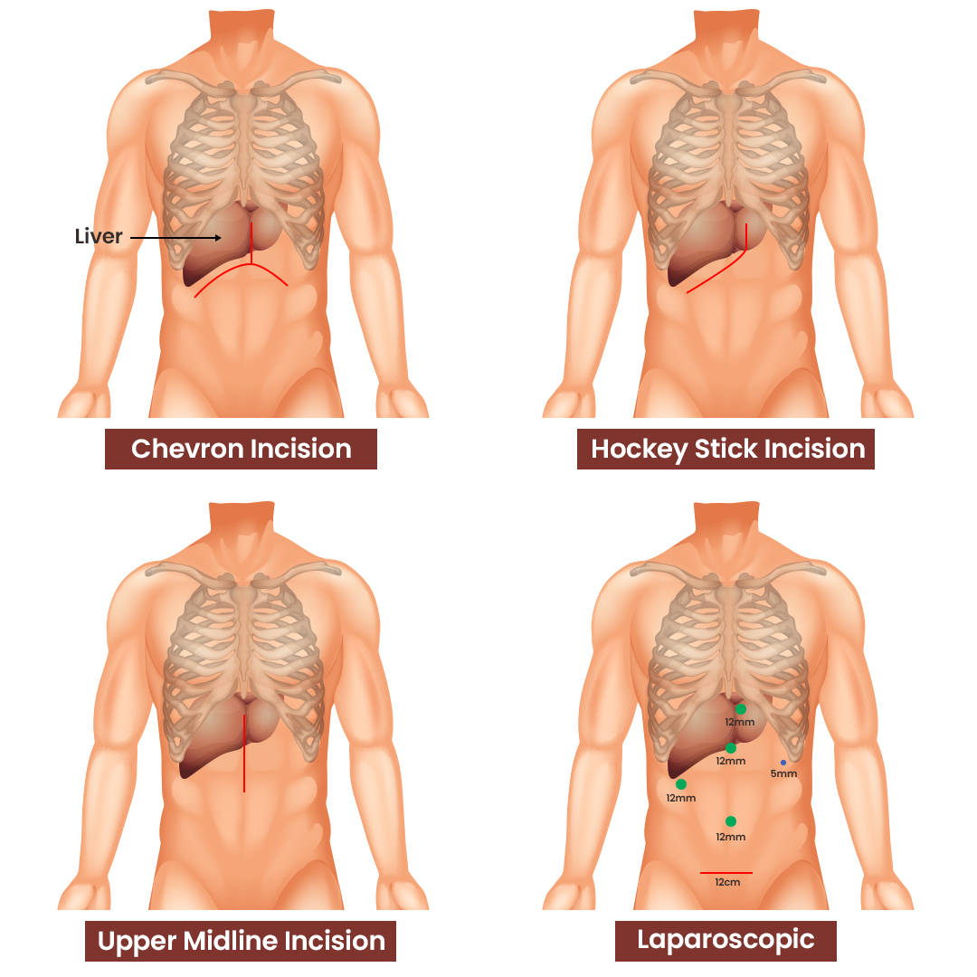 Liver Laparoscopic Surgery Hospital In Delhi Ncr Ailbs