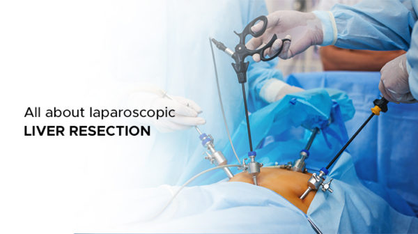 Everything You Need To Know About Laparoscopic Liver Resection -AILBS India