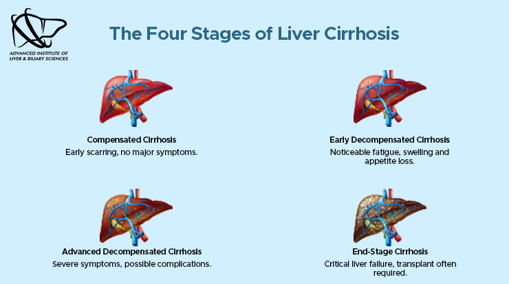 four stages of liver cirrhosis